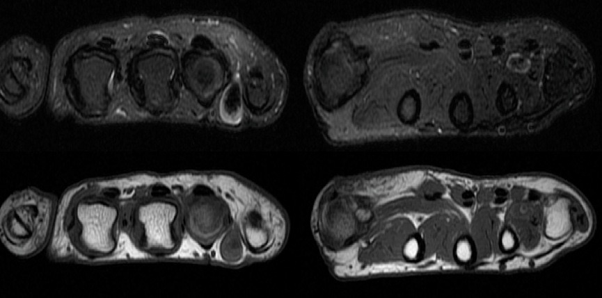 Figure 2 for case Venous malformation ( RID3337 )